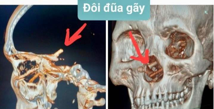 Người đàn ông không biết bị đôi đũa đâm xuyên sọ não suốt 5 tháng